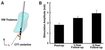 Active contact proximity to the cerebellothalamic tract predicts initial therapeutic current requirement with DBS for ET: an application of 7T MRI